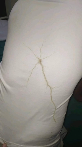 लिगलिगकोटमा चट्याङ लागेर एक जना घाइते,