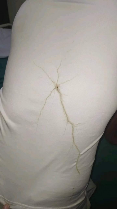 लिगलिगकोटमा चट्याङ लागेर एक जना घाइते,